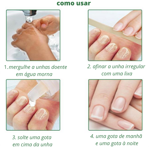 Tratamento para Micose e Fungos Para Unhas